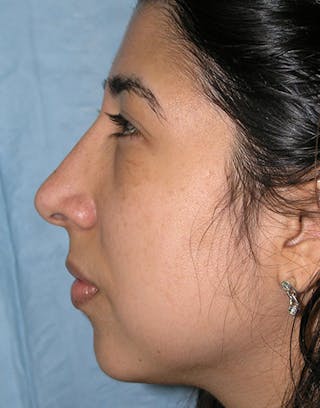 Rhinoplasty Before & After Gallery - Patient 435456 - Image 2