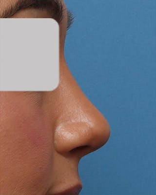 Rhinoplasty Before & After Gallery - Patient 390427 - Image 2