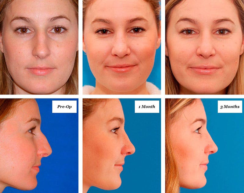 Rhinoplasty Healing Stages Before & After Gallery - Patient 274202 - Image 1