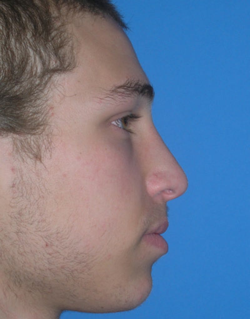 Foundation Rhinoplasty / Crooked Nose Before & After Gallery - Patient 111736 - Image 4