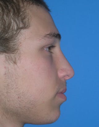 Rhinoplasty Before & After Gallery - Patient 245160 - Image 4