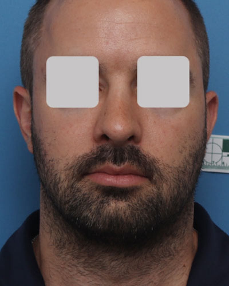 Male Rhinoplasty Before & After Gallery - Patient 202741 - Image 4