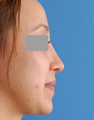 Favorite Revision Rhinoplasty Before & After Gallery - Patient 234951 - Image 2