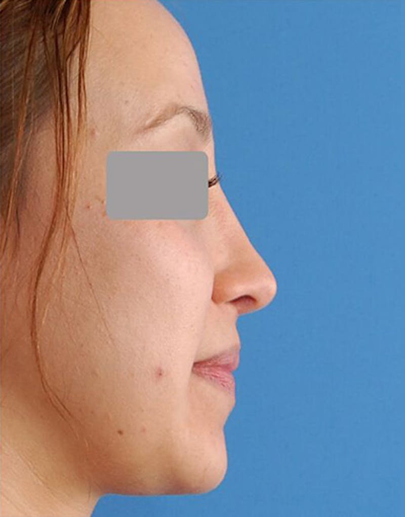 Revision Rhinoplasty Before & After Gallery - Patient 279777 - Image 2