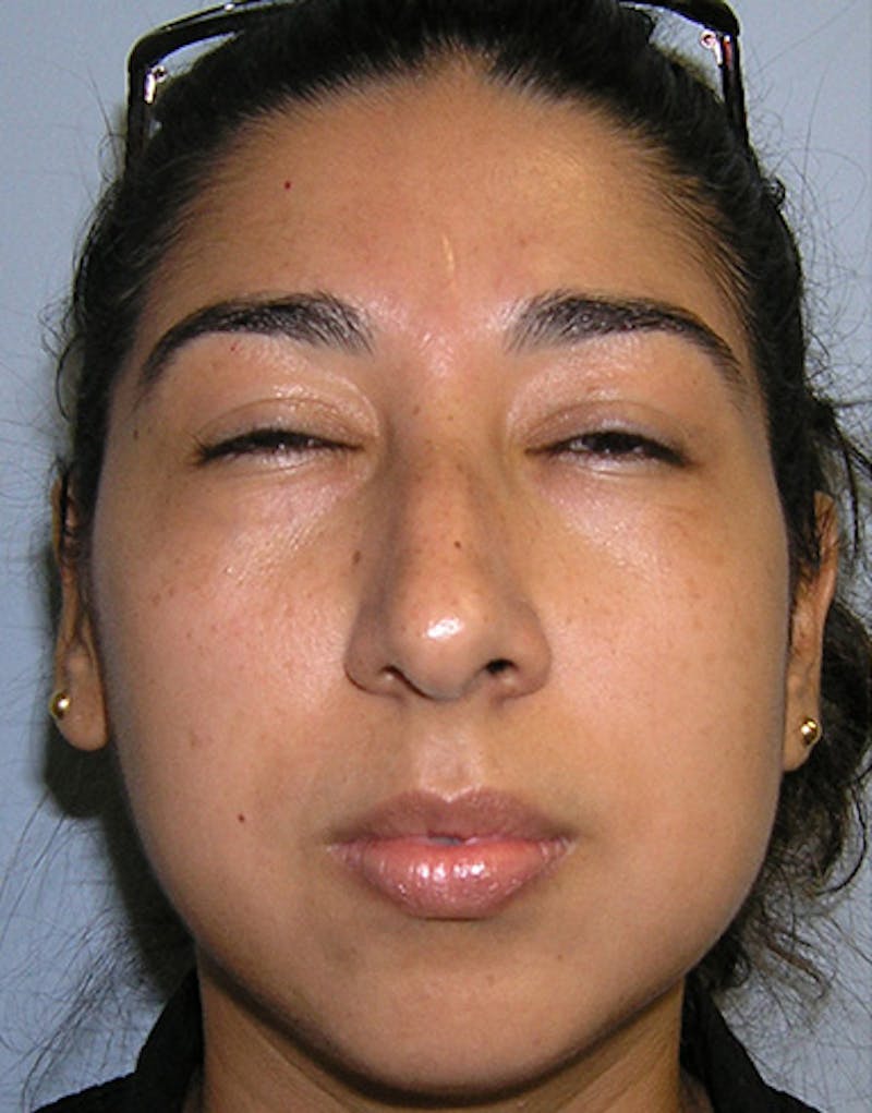 Ethnic Rhinoplasty Before & After Gallery - Patient 274152 - Image 3