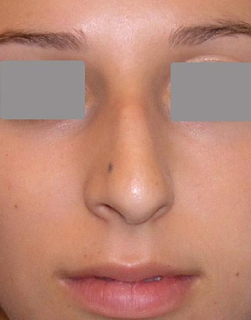 Rhinoplasty Before & After Gallery - Patient 237131 - Image 3