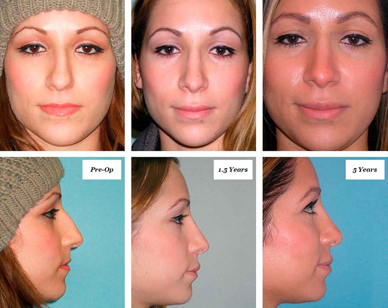 Rhinoplasty Healing Stages Before & After Gallery - Patient 728549 - Image 1