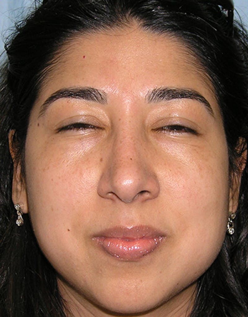 Ethnic Rhinoplasty Before & After Gallery - Patient 274152 - Image 4