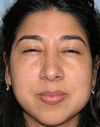 Rhinoplasty Before & After Gallery - Patient 435456 - Image 4