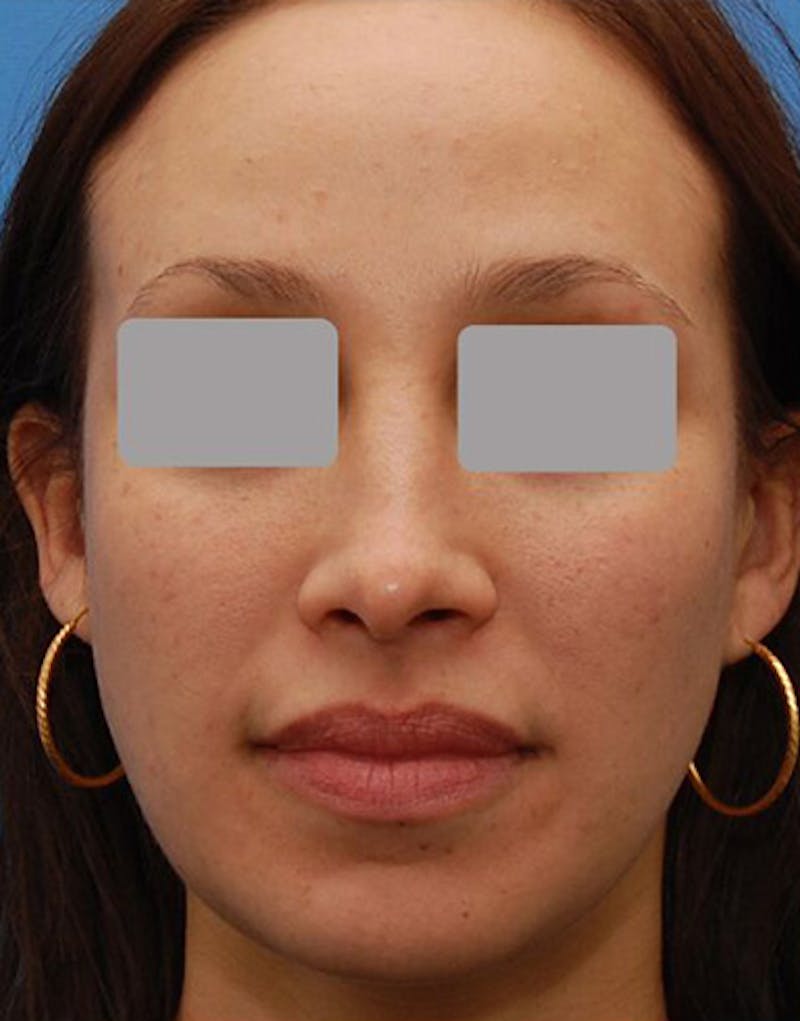 Revision Rhinoplasty Before & After Gallery - Patient 279777 - Image 3