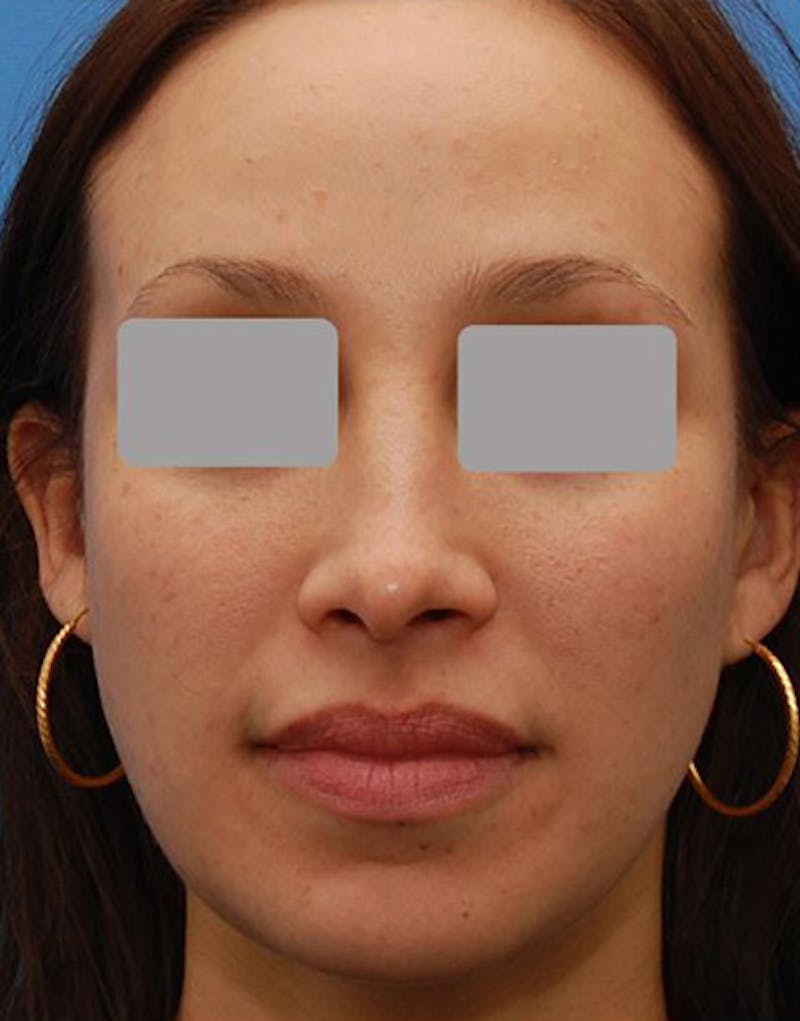 Favorite Revision Rhinoplasty Before & After Gallery - Patient 234951 - Image 3