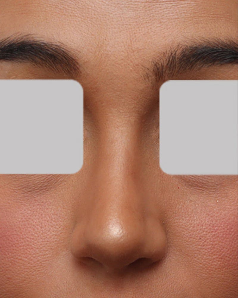 Rhinoplasty Before & After Gallery - Patient 237131 - Image 4
