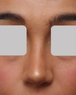 Rhinoplasty Before & After Gallery - Patient 390427 - Image 4