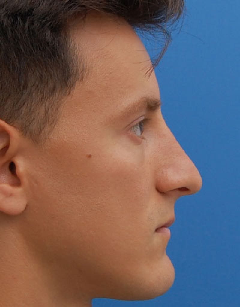 Patient EYVABD9IRKWITzCjahvmvw - Male Rhinoplasty Before & After Photos