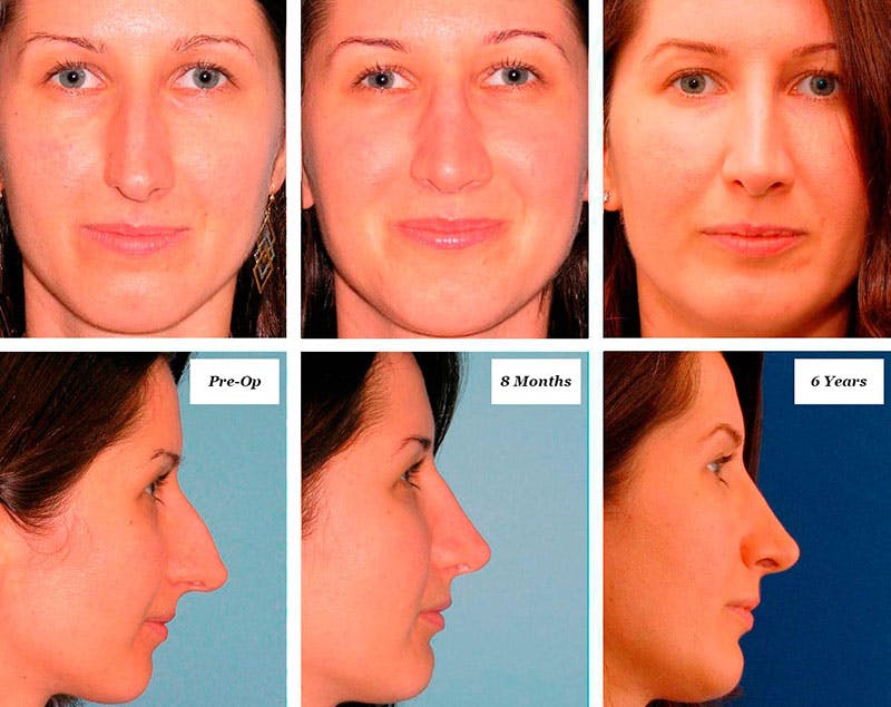 Rhinoplasty Healing Stages Before & After Gallery - Patient 151574 - Image 1