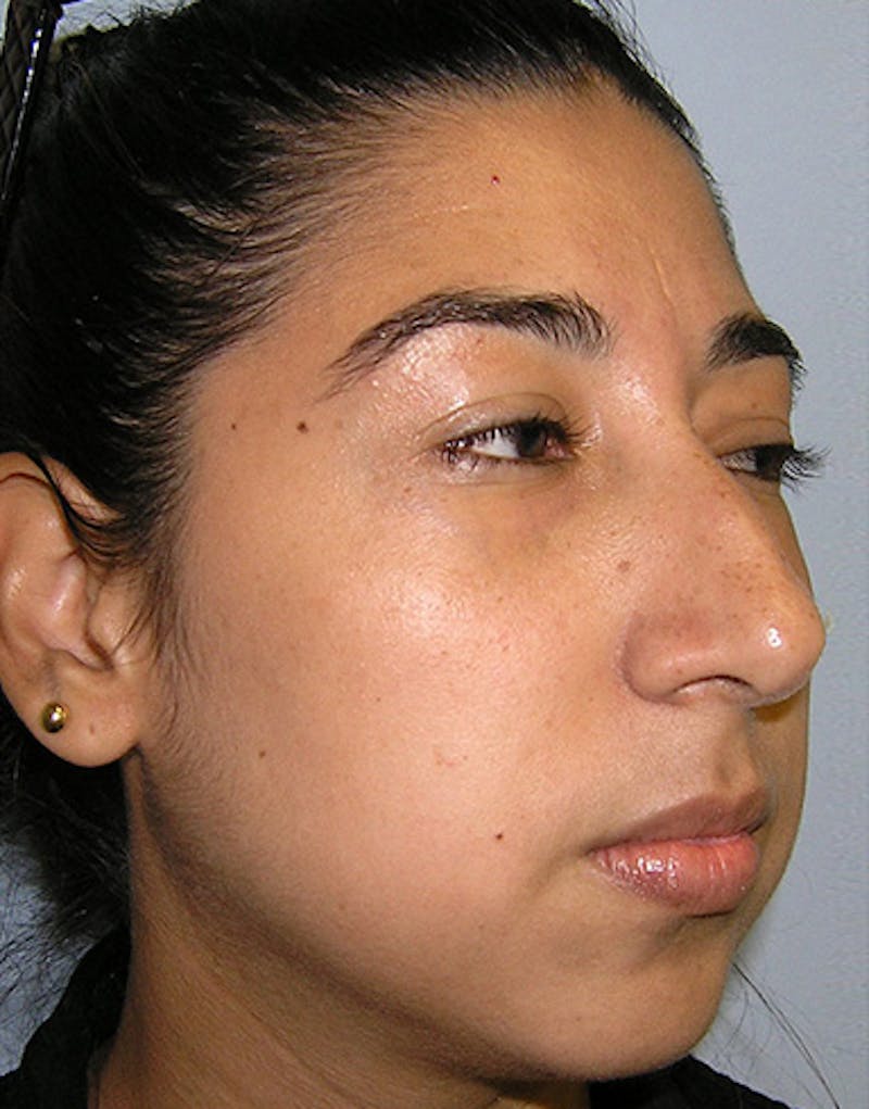 Ethnic Rhinoplasty Before & After Gallery - Patient 274152 - Image 5