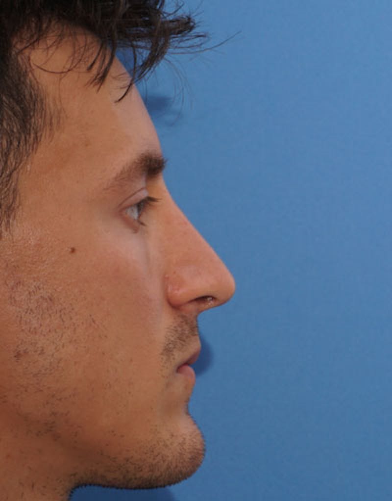 Male Rhinoplasty Before & After Gallery - Patient 287131 - Image 2