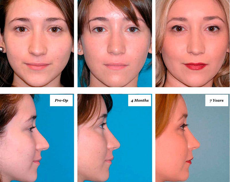 Rhinoplasty Healing Stages Before & After Gallery - Patient 133014 - Image 1