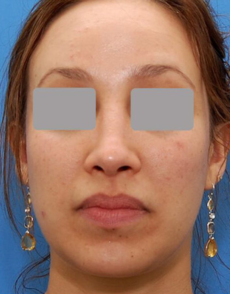 Revision Rhinoplasty Before & After Gallery - Patient 279777 - Image 4