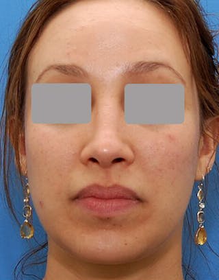 Favorite Revision Rhinoplasty Before & After Gallery - Patient 234951 - Image 4