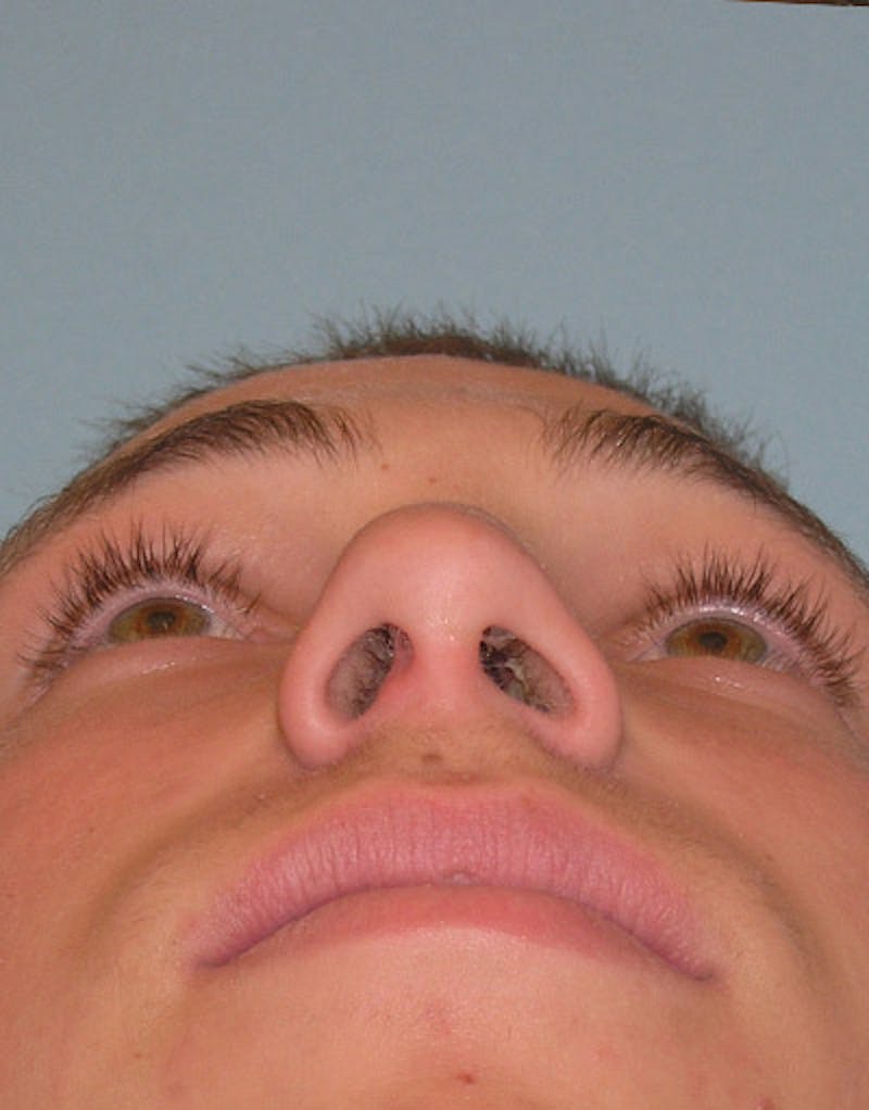 Rhinoplasty  Before & After Gallery - Patient 245160 - Image 7