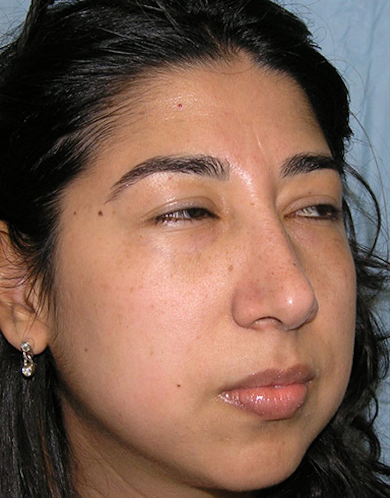 Ethnic Rhinoplasty Before & After Gallery - Patient 274152 - Image 6