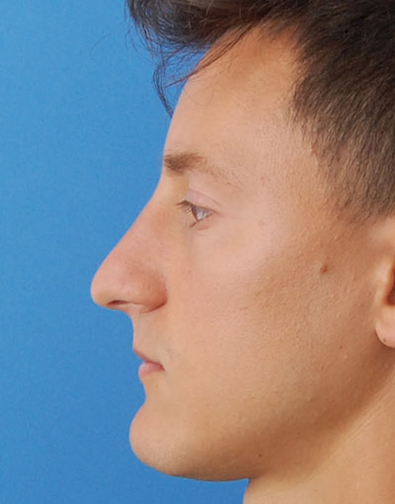 Male Rhinoplasty Before & After Gallery - Patient 287131 - Image 3
