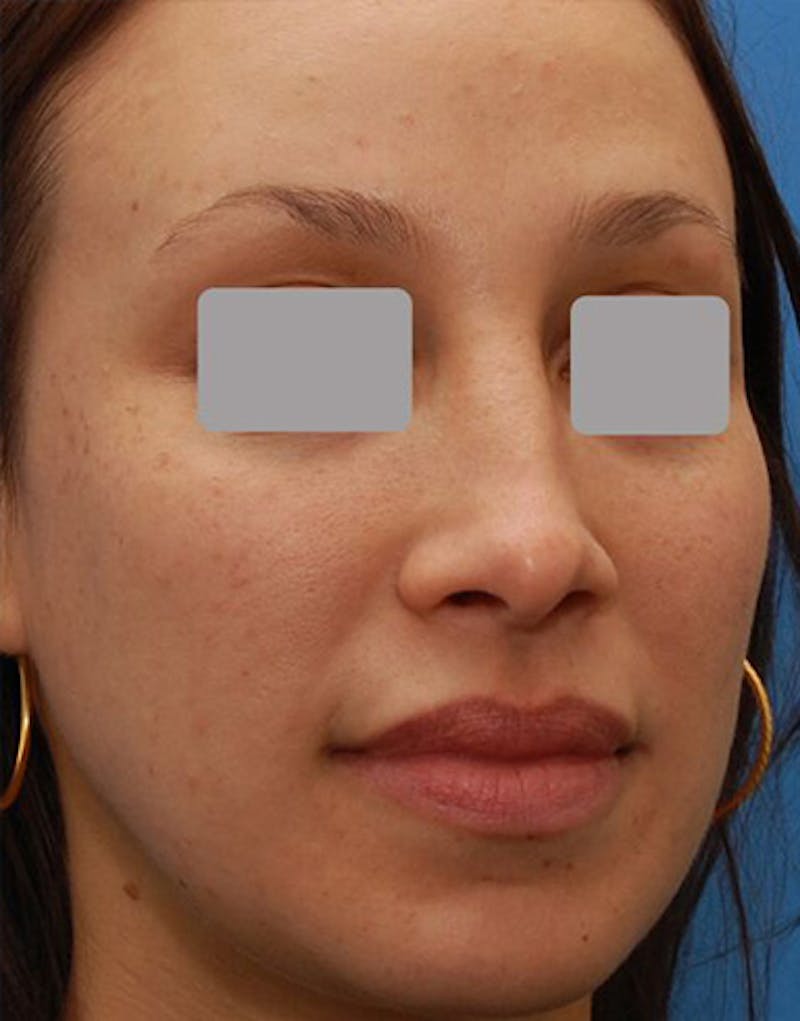 Favorite Revision Rhinoplasty Before & After Gallery - Patient 234951 - Image 5