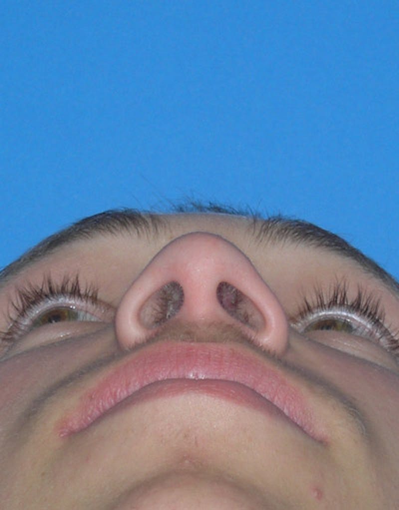 Rhinoplasty  Before & After Gallery - Patient 245160 - Image 8