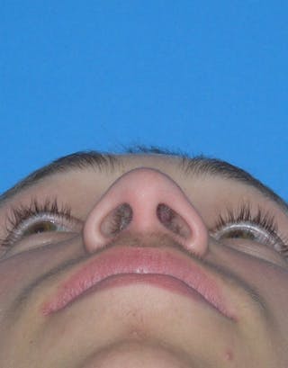 Rhinoplasty Before & After Gallery - Patient 245160 - Image 8