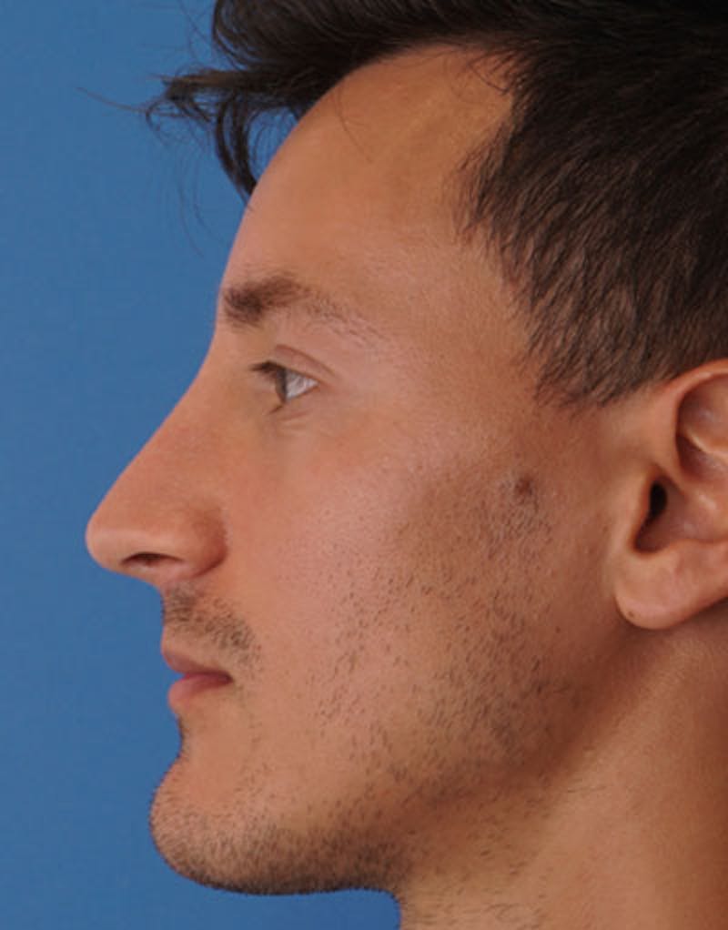 Male Rhinoplasty Before & After Gallery - Patient 287131 - Image 4