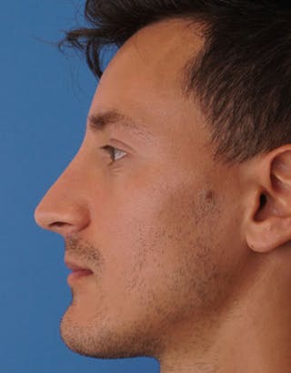 Favorite Male Rhinoplasty Before & After Gallery - Patient 383401 - Image 4