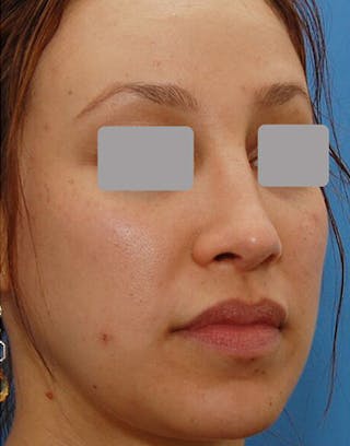 Favorite Revision Rhinoplasty Before & After Gallery - Patient 234951 - Image 6