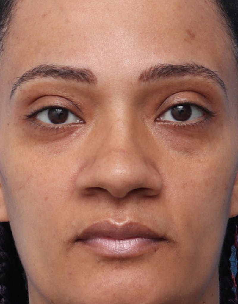 Ethnic Rhinoplasty Before & After Gallery - Patient 392768 - Image 1