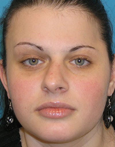 Rhinoplasty Before & After Gallery - Patient 233755 - Image 1