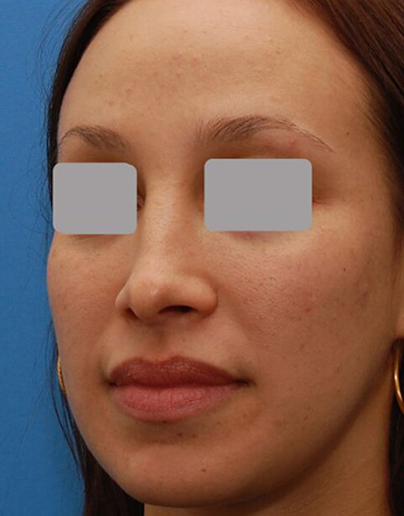 Favorite Revision Rhinoplasty Before & After Gallery - Patient 234951 - Image 7