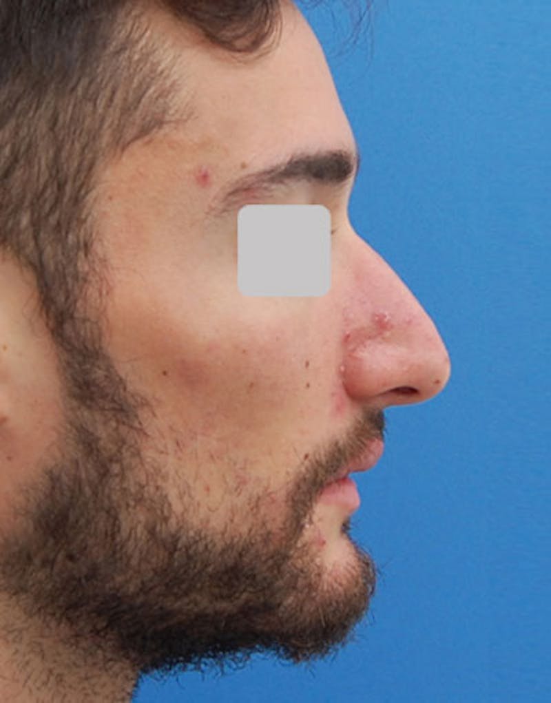Patient B_rv8nqLTHaaLDD3qAjqzQ - Male Rhinoplasty Before & After Photos