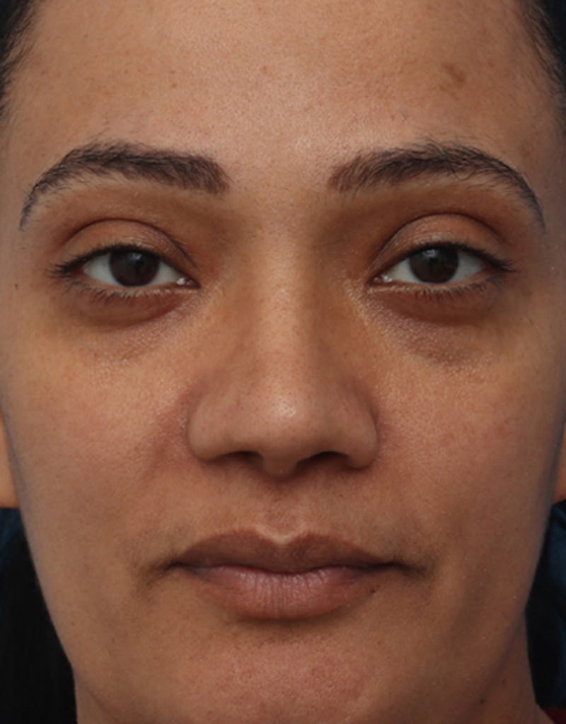 Ethnic Rhinoplasty Before & After Gallery - Patient 392768 - Image 2