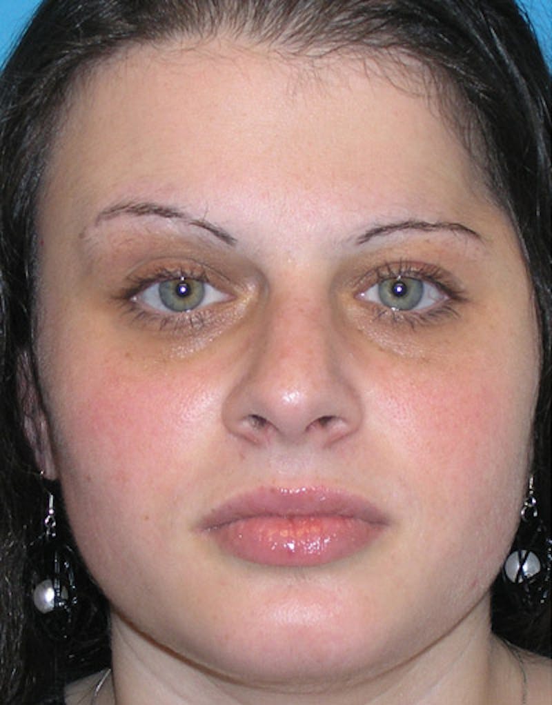 Foundation Rhinoplasty / Crooked Nose Before & After Gallery - Patient 118527 - Image 2
