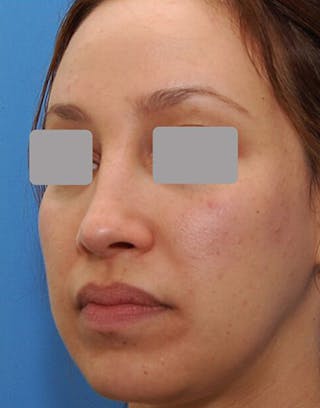 Favorite Revision Rhinoplasty Before & After Gallery - Patient 234951 - Image 8