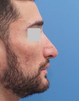 Rhinoplasty Before & After Gallery - Patient 138556 - Image 2