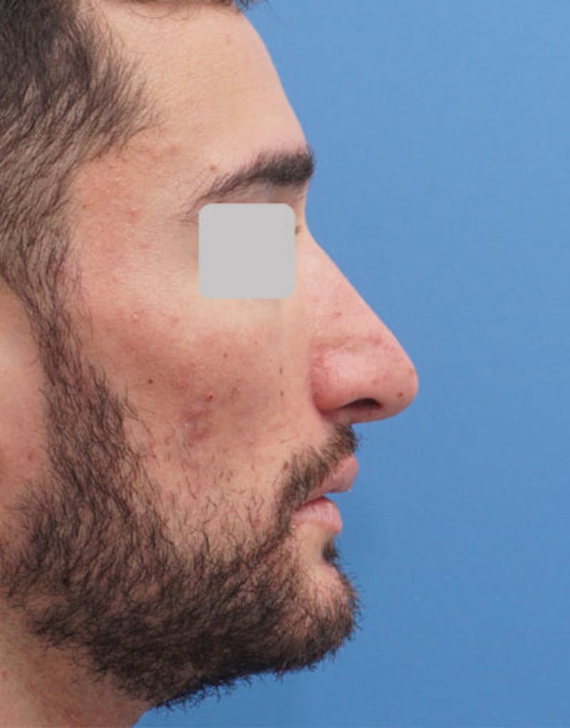 Male Rhinoplasty Before & After Gallery - Patient 380813 - Image 2