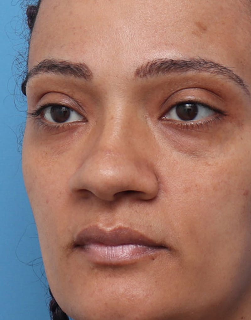 Ethnic Rhinoplasty Before & After Gallery - Patient 392768 - Image 3