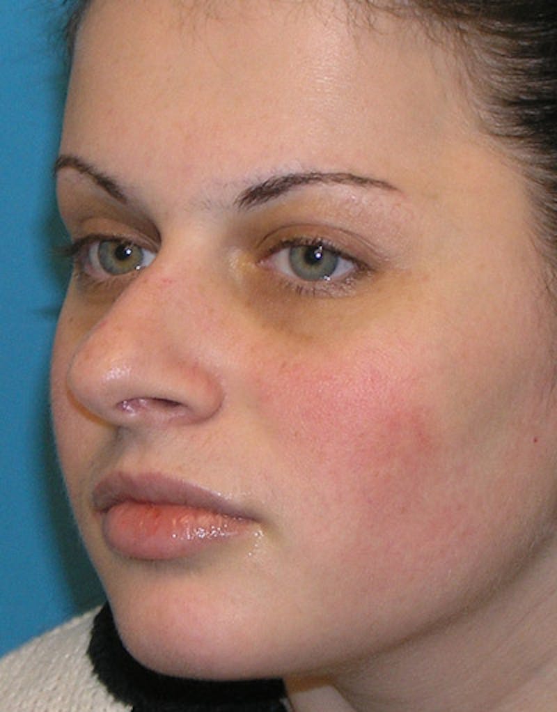 Foundation Rhinoplasty / Crooked Nose Before & After Gallery - Patient 118527 - Image 3