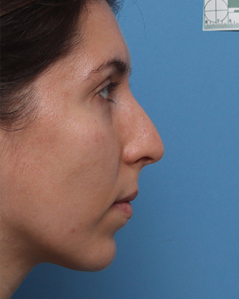 Rhinoplasty Before & After Gallery - Patient 376775 - Image 1