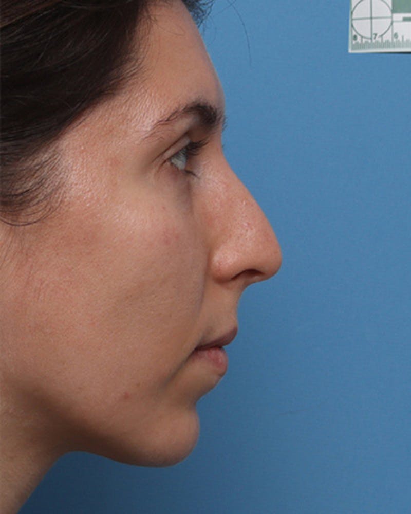 Patient CNatgCYQS3OJ-kiIwwRMdA - Rhinoplasty Before & After Photos