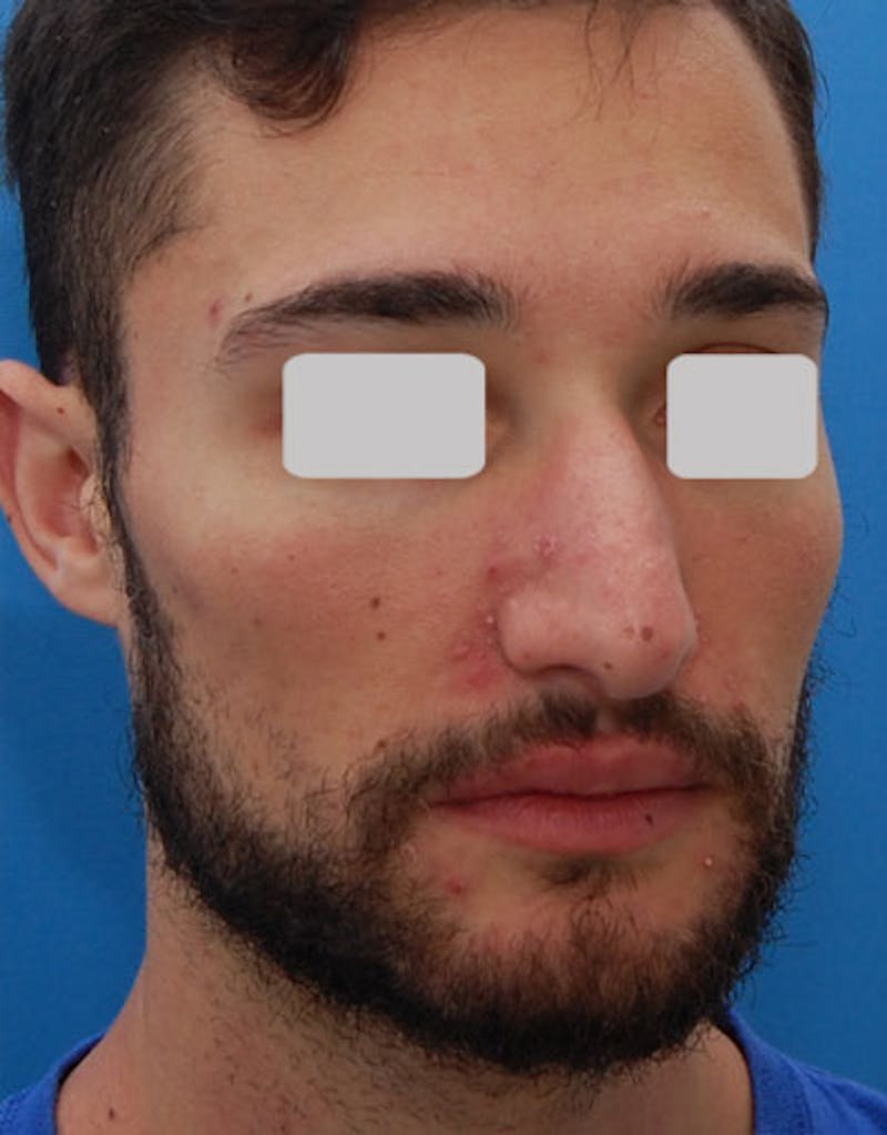 Male Rhinoplasty Before & After Gallery - Patient 380813 - Image 3