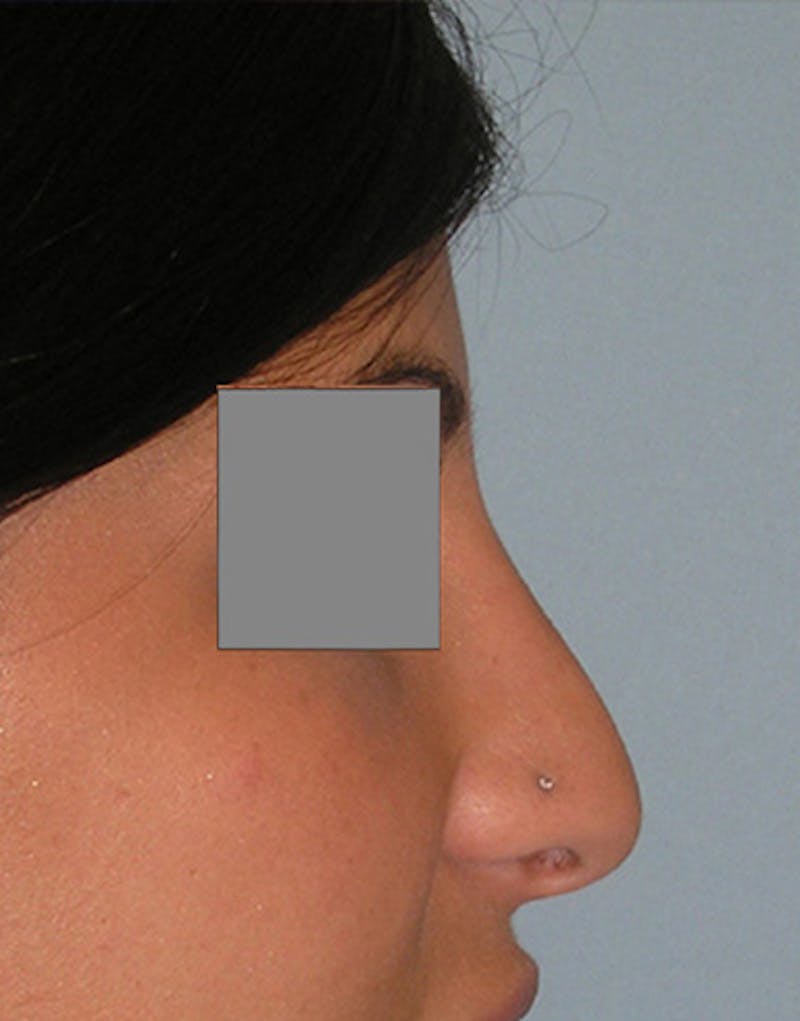 Revision Rhinoplasty Before & After Gallery - Patient 187105 - Image 1