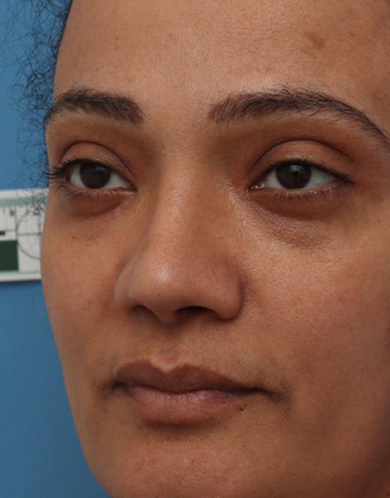 Ethnic Rhinoplasty Before & After Gallery - Patient 392768 - Image 4