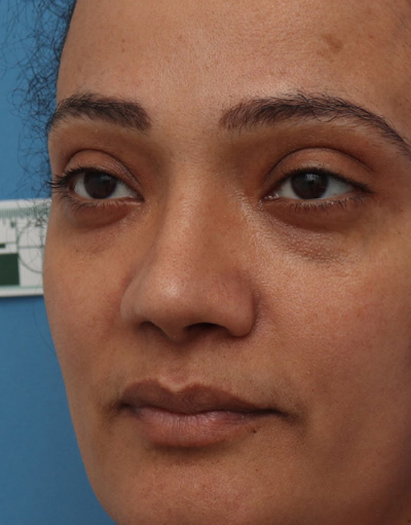 Rhinoplasty  Before & After Gallery - Patient 311155 - Image 4